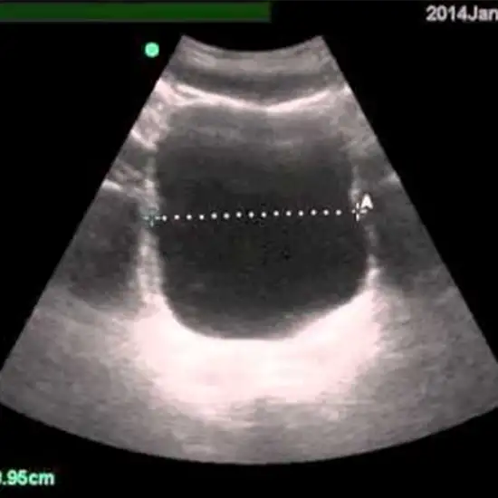 Ultrasound PVR (Post Void Residual)